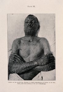 Homem infectado com varíola mostrando as erupções pelo corpo